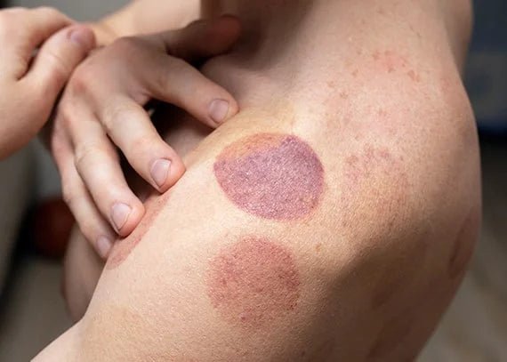 The Revival of Cupping Therapy: An Ancient Technique for Modern Wellness - Health Zone